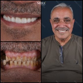Before and after dental veneers result at Mira Clinic, improved smile and whiter teeth