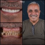 Before and after dental veneers result at Mira Clinic, improved smile and whiter teeth