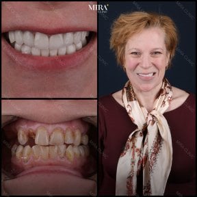 Before and after dental veneers at Mira Clinic, smile transformation and whiter teeth result