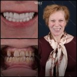Before and after dental veneers at Mira Clinic, smile transformation and whiter teeth result