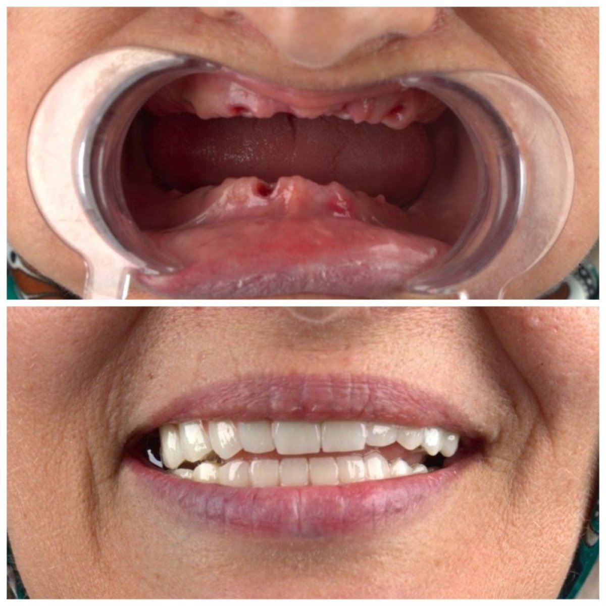 Resultado antes y después de implantes All-on-4 en SUAVE DENTAL CLINIC, sonrisa restaurada