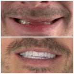 Before and after All-on-4 dental implants result at SUAVE DENTAL CLINIC, restored smile