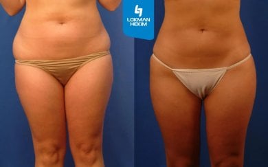 before-after photo vaser-liposuction