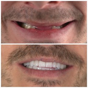 before-after photo dental-implant