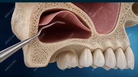 Before and after Bone Graft photos by Dr. 
