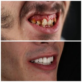 before-after photo dental-implant