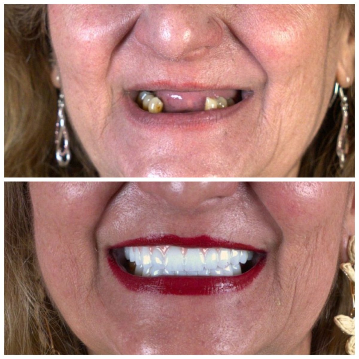 Resultados antes y después de implantes All-on-6 en SUAVE DENTAL CLINIC, restauración de sonrisa
