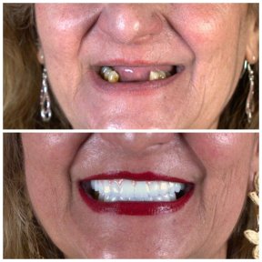 before-after photo all-on-6-dental-implants