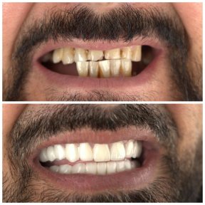 before-after photo all-on-6-dental-implants