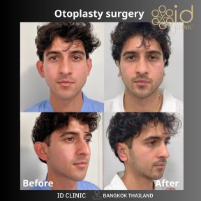before-after photo otoplasty-ear-surgery