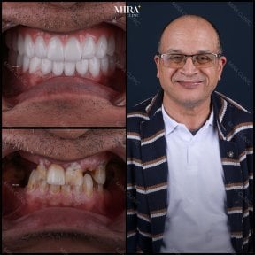 before-after photo dental-implant