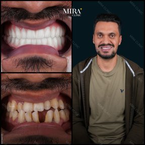 before-after photo dental-implant