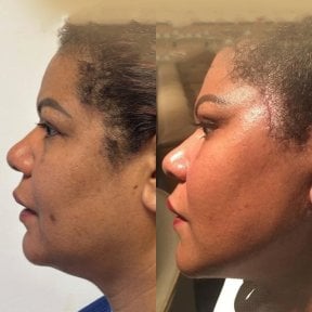 before-after photo endoscopic-facelift