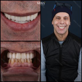 before-after photo sinus-lifting