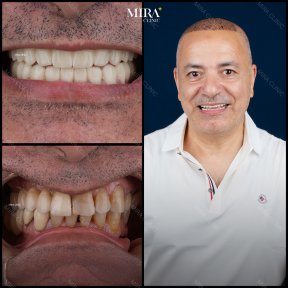 before-after photo sinus-lifting