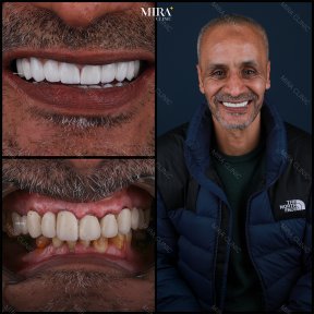 before-after photo sinus-lifting