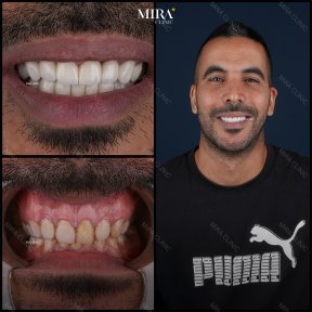 before-after photo sinus-lifting