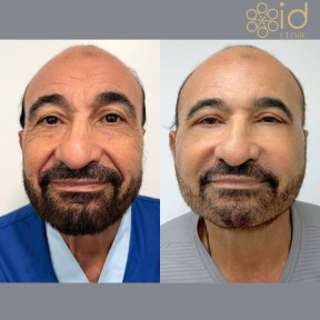 before-after photo deep-plane-facelift