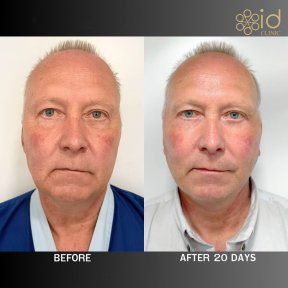 before-after photo deep-plane-facelift