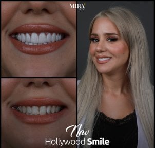 Before and after zirconia crown results at Mira Clinic, Hollywood Smile transformation