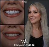 Before and after zirconia crown results at Mira Clinic, Hollywood Smile transformation