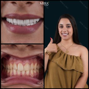 Zirconia crown before and after results at Mira Clinic, smile makeover with whiter teeth