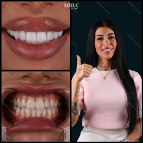 Zirconia crown installation results at Mira Clinic SAĞLIK TURİZM ŞİRKETİ, smile makeover