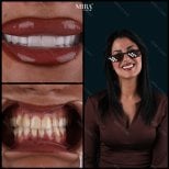 Before and after zirconia crown results at Mira Clinic, smile makeover with whiter teeth