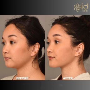 before-after photo vaser-liposuction