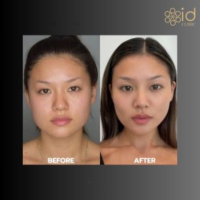 before-after photo vaser-liposuction
