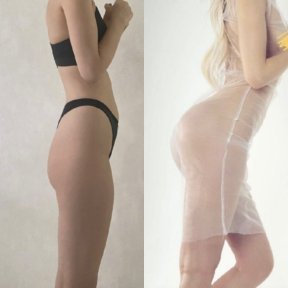 before-after photo buttock-implants