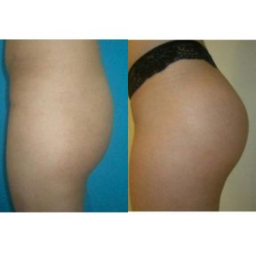 before-after photo buttock-implants
