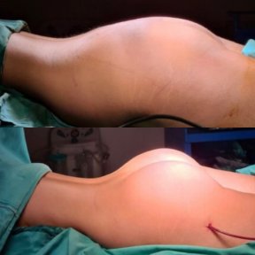 before-after photo buttock-implants