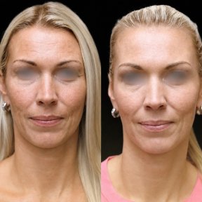 before-after photo lipofilling