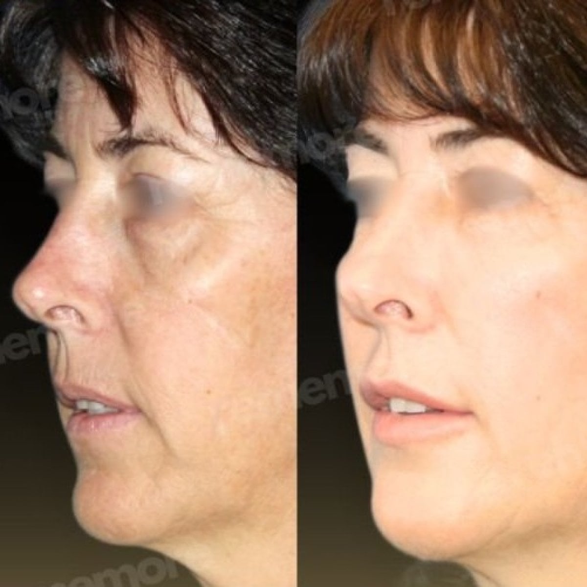 Resultados de lipofilling antes y después en Memorial Şişli Hospital, restauración facial