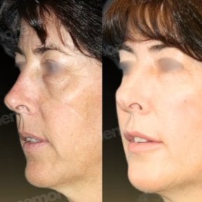 before-after photo lipofilling