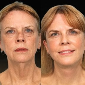 before-after photo lipofilling