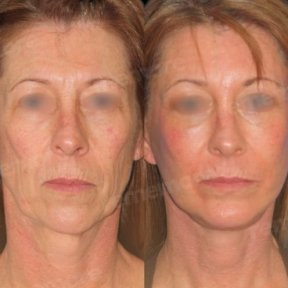 before-after photo lipofilling