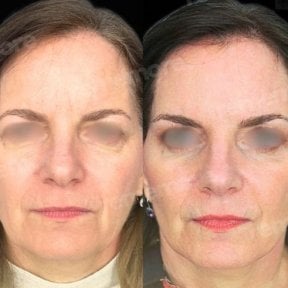 before-after photo lipofilling