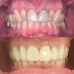 before-after photo zirconia-crown-installation