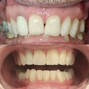 before-after photo zirconia-crown-installation