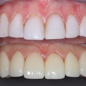 before-after photo zirconia-crown-installation