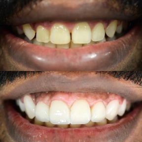 before-after photo smile-makeover