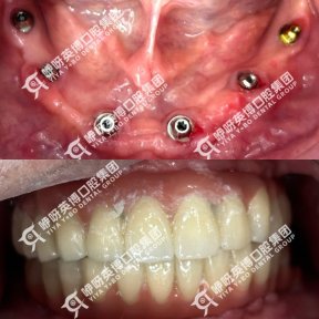 before-after photo immediate-all-on-4-dental-implants