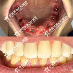before-after photo immediate-all-on-4-dental-implants