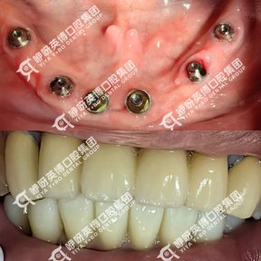 before-after photo immediate-all-on-4-dental-implants