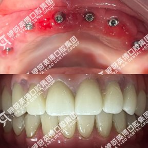 before-after photo immediate-all-on-4-dental-implants