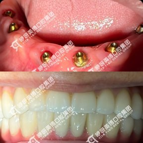 before-after photo immediate-all-on-4-dental-implants