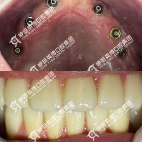 before-after photo immediate-all-on-4-dental-implants