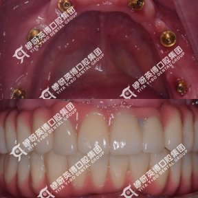 before-after photo immediate-all-on-4-dental-implants